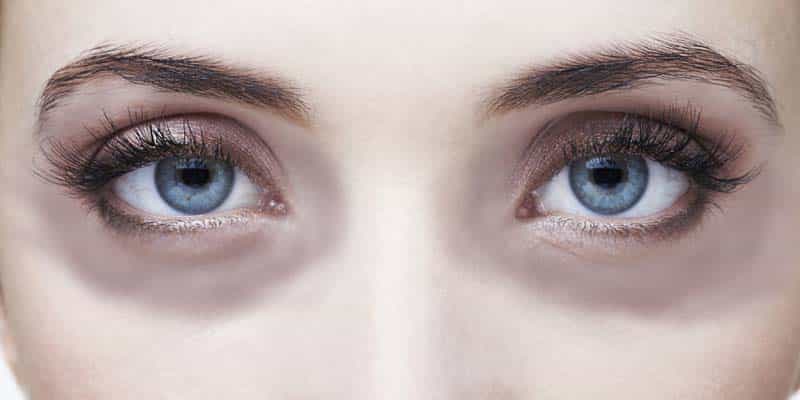 Dark circles quick home remedies