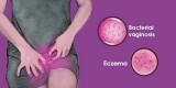 Yeast Infections: You Must Need to Know Everything About it