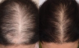 Stem Cell Hair Restoration A Breakthrough in Hair Loss Treatment