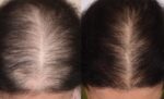 Stem Cell Hair Restoration A Breakthrough in Hair Loss Treatment